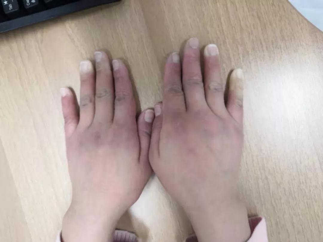 “手指、腳趾發(fā)白、發(fā)紫……”這些“小毛病”千萬(wàn)別大意
