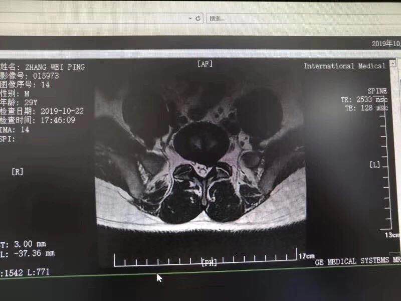 西安國際醫(yī)學中心骨科醫(yī)院成功完成首臺椎間孔鏡手術