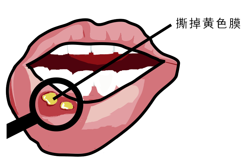 經(jīng)常口腔潰瘍，真的只是缺維生素嗎？