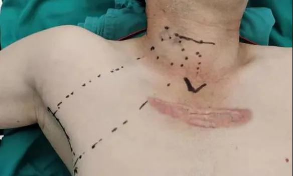 術(shù)后傷口可以“隱身”嗎？