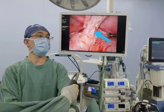 30歲小伙持續(xù)發(fā)燒咳嗽，原來(lái)是多長(zhǎng)一塊肺......