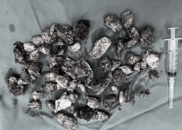 大腦一半是腫瘤 13歲少女在醫生助力下勇闖生命難關