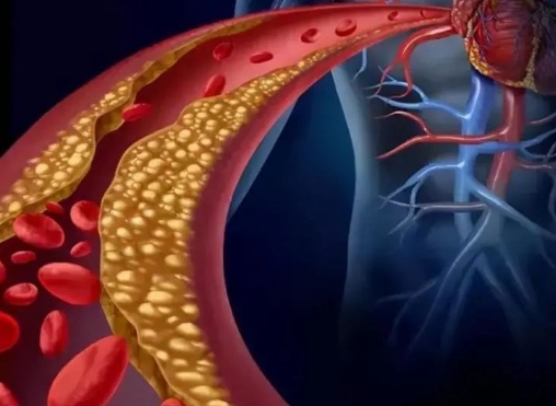 警惕！冠脈支架術后這些誤區千萬別踩，趕緊收藏！