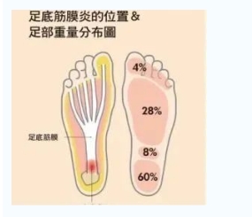 每年新生數百萬足底筋膜炎患者！國際醫學專家提醒：跑步要選擇合適的鞋