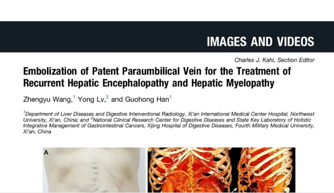 我院護理團隊臨床成果登榜國際肝病權威期刊，影響因子11.6
