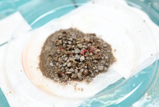 密集恐懼癥慎入！男子腎臟里取出上萬顆沙石